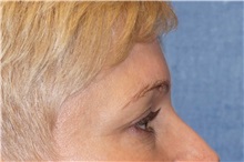 Eyelid Surgery Before Photo by George John Alexander, MD, FACS; ,  - Case 32721