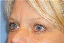 Brow Lift After Photo by George John Alexander, MD, FACS; ,  - Case 32722