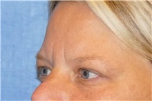 Brow Lift Before Photo by George John Alexander, MD, FACS; ,  - Case 32722