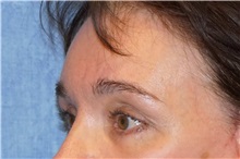 Brow Lift After Photo by George John Alexander, MD, FACS; ,  - Case 32724
