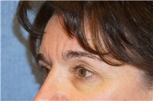 Brow Lift Before Photo by George John Alexander, MD, FACS; ,  - Case 32724