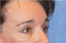 Brow Lift After Photo by George John Alexander, MD, FACS; ,  - Case 32724