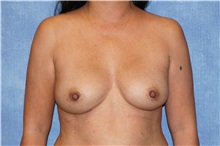 Breast Implant Removal After Photo by George John Alexander, MD, FACS; Las Vegas, NV - Case 32736