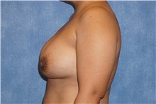 Breast Implant Removal Before Photo by George John Alexander, MD, FACS; ,  - Case 32739