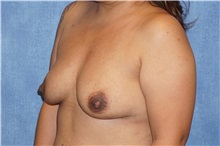 Breast Implant Removal After Photo by George John Alexander, MD, FACS; ,  - Case 32739