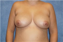 Breast Implant Removal After Photo by George John Alexander, MD, FACS; Las Vegas, NV - Case 32740