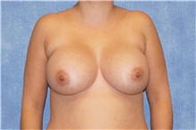 Breast Implant Removal Before Photo by George John Alexander, MD, FACS; Las Vegas, NV - Case 32740