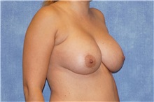 Breast Implant Removal Before Photo by George John Alexander, MD, FACS; ,  - Case 32740