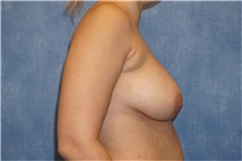 Breast Implant Removal After Photo by George John Alexander, MD, FACS; ,  - Case 32740