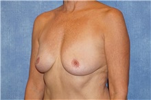 Breast Implant Removal After Photo by George John Alexander, MD, FACS; ,  - Case 32742