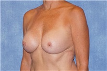 Breast Implant Removal Before Photo by George John Alexander, MD, FACS; ,  - Case 32742