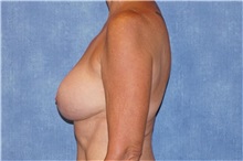 Breast Implant Removal Before Photo by George John Alexander, MD, FACS; ,  - Case 32742