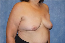 Breast Implant Removal After Photo by George John Alexander, MD, FACS; ,  - Case 32743