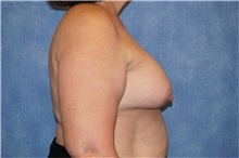 Breast Implant Removal Before Photo by George John Alexander, MD, FACS; ,  - Case 32743