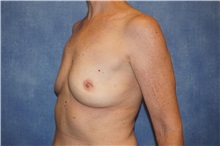 Breast Implant Removal After Photo by George John Alexander, MD, FACS; Las Vegas, NV - Case 32744