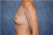 Breast Implant Removal After Photo by George John Alexander, MD, FACS; Las Vegas, NV - Case 32744