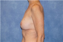Breast Implant Removal Before Photo by George John Alexander, MD, FACS; Las Vegas, NV - Case 32744