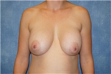 Breast Implant Removal Before Photo by George John Alexander, MD, FACS; ,  - Case 32746