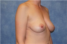Breast Implant Removal After Photo by George John Alexander, MD, FACS; ,  - Case 32746
