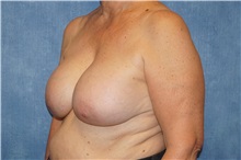 Breast Implant Removal Before Photo by George John Alexander, MD, FACS; Las Vegas, NV - Case 32747