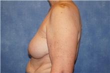 Breast Implant Removal After Photo by George John Alexander, MD, FACS; Las Vegas, NV - Case 32747