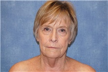 Facelift Before Photo by George John Alexander, MD, FACS; ,  - Case 32749