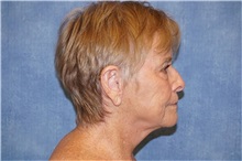 Facelift After Photo by George John Alexander, MD, FACS; ,  - Case 32749