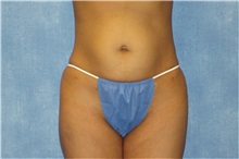 Liposuction After Photo by George John Alexander, MD, FACS; ,  - Case 32750