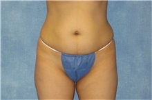Liposuction Before Photo by George John Alexander, MD, FACS; ,  - Case 32750
