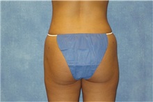 Liposuction After Photo by George John Alexander, MD, FACS; ,  - Case 32750