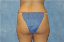 Liposuction Before Photo by George John Alexander, MD, FACS; ,  - Case 32750