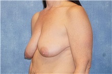 Breast Lift Before Photo by George John Alexander, MD, FACS; ,  - Case 33254