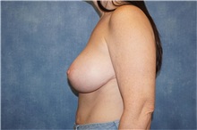 Breast Lift After Photo by George John Alexander, MD, FACS; ,  - Case 33254