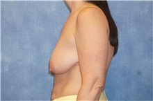 Breast Lift Before Photo by George John Alexander, MD, FACS; ,  - Case 33254