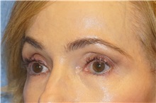 Brow Lift After Photo by George John Alexander, MD, FACS; ,  - Case 33882