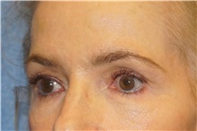 Brow Lift Before Photo by George John Alexander, MD, FACS; ,  - Case 33882