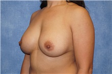 Breast Augmentation After Photo by George John Alexander, MD, FACS; ,  - Case 33885