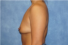 Breast Augmentation Before Photo by George John Alexander, MD, FACS; ,  - Case 33885