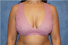 Breast Augmentation After Photo by George John Alexander, MD, FACS; ,  - Case 33885