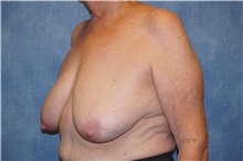 Breast Reduction Before Photo by George John Alexander, MD, FACS; ,  - Case 33886