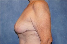 Breast Reduction After Photo by George John Alexander, MD, FACS; ,  - Case 33886