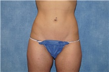 Liposuction After Photo by George John Alexander, MD, FACS; ,  - Case 33890