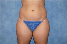 Liposuction Before Photo by George John Alexander, MD, FACS; ,  - Case 33890