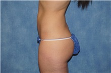 Liposuction After Photo by George John Alexander, MD, FACS; ,  - Case 33890