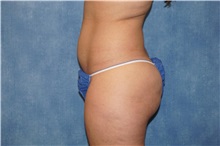 Liposuction Before Photo by George John Alexander, MD, FACS; ,  - Case 33890