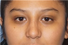 Rhinoplasty After Photo by George John Alexander, MD, FACS; Las Vegas, NV - Case 34054