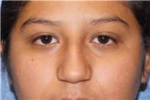 Rhinoplasty Before Photo by George John Alexander, MD, FACS; Las Vegas, NV - Case 34054