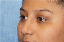 Rhinoplasty After Photo by George John Alexander, MD, FACS; Las Vegas, NV - Case 34054