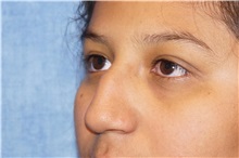 Rhinoplasty Before Photo by George John Alexander, MD, FACS; Las Vegas, NV - Case 34054