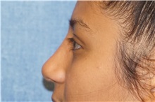 Rhinoplasty After Photo by George John Alexander, MD, FACS; Las Vegas, NV - Case 34054